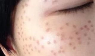 激光去雀斑大概多少钱 激光治疗雀斑的价格